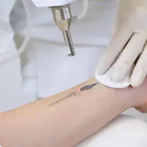 4 sesiones de borrado de tatuajes 6x1