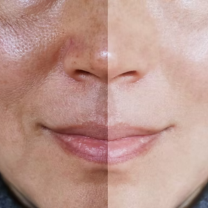 Despigmentantes Faciales