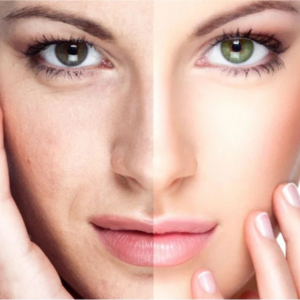 Rejuvenecimiento Facial