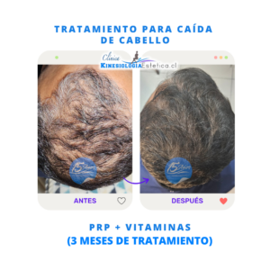 Abono de PRP+ vitaminas de cabello