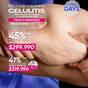 Ondas de Choque + Laserlipólisis para Celulitis 8 ses.