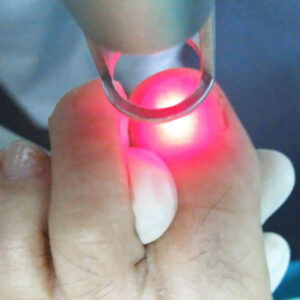 4 sesiones en 6 uñas onicomicosis